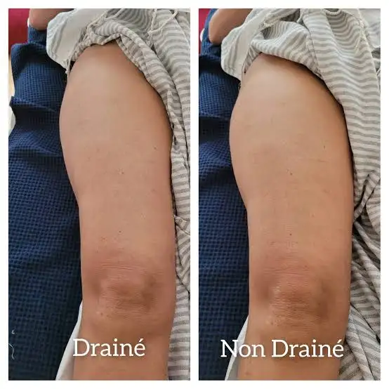 Photo 1 de Drainage Lymphatique chez Mince et Belle 