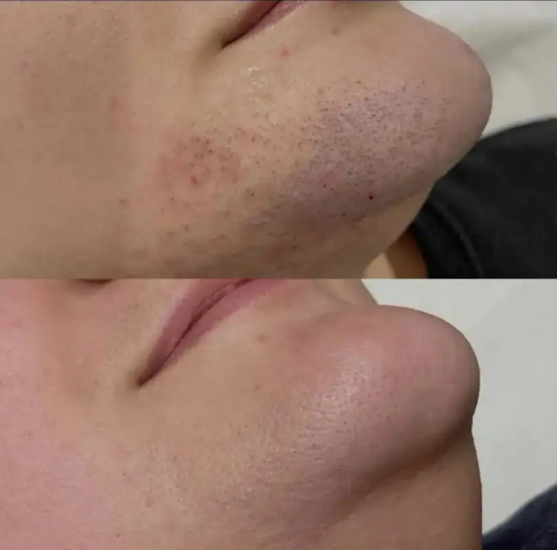 Photo 1 de Peeling - La Perla Esthétique