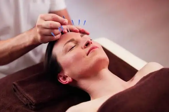 Acupuncture chez Belle et Mince 